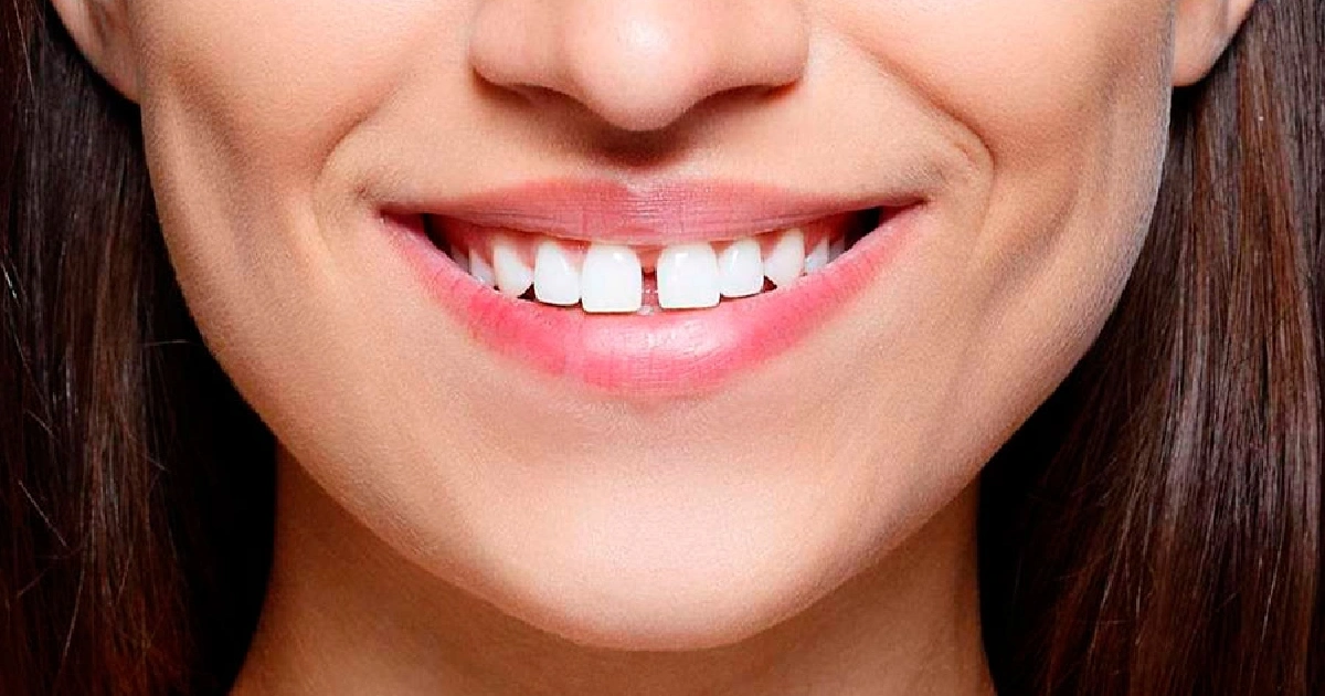 Dentes de mentiroso