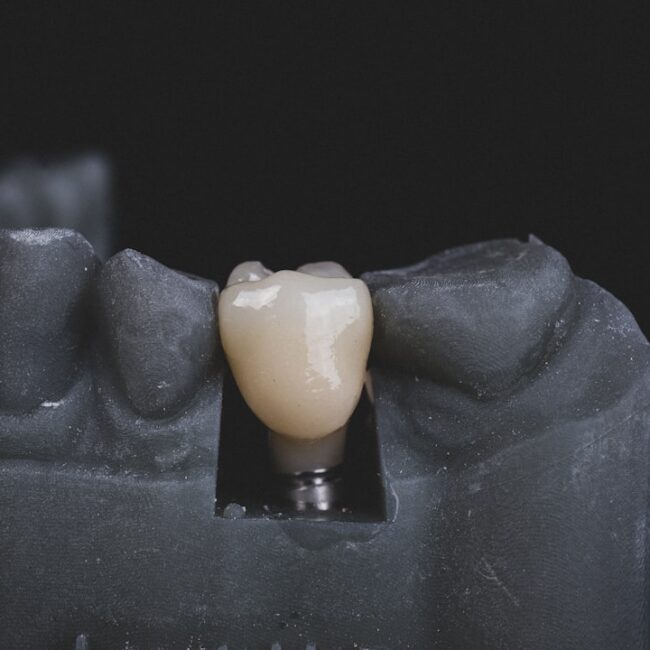 Photo Dental implant